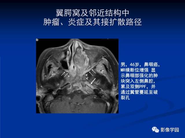 【PPT】翼腭窝PPF的解剖及影像学评价