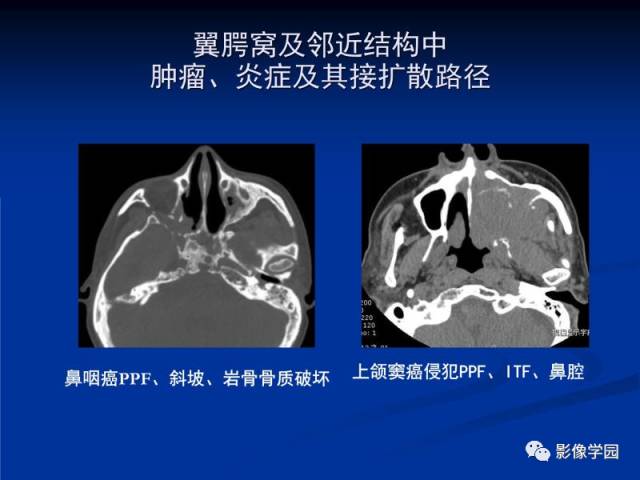 【PPT】翼腭窝PPF的解剖及影像学评价