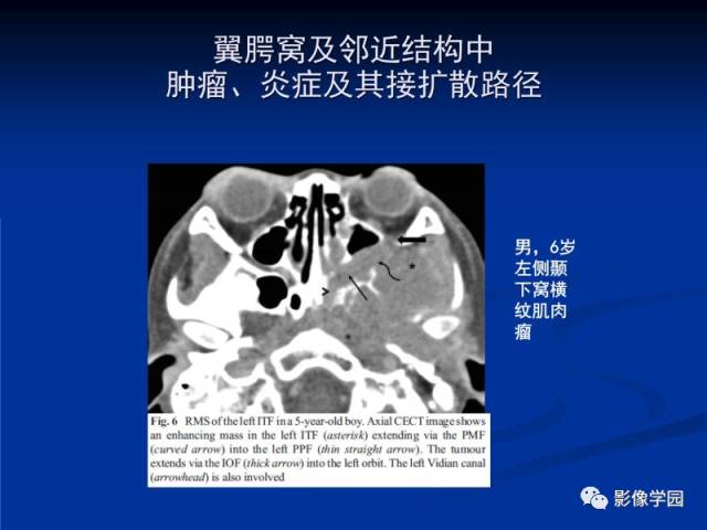 【PPT】翼腭窝PPF的解剖及影像学评价