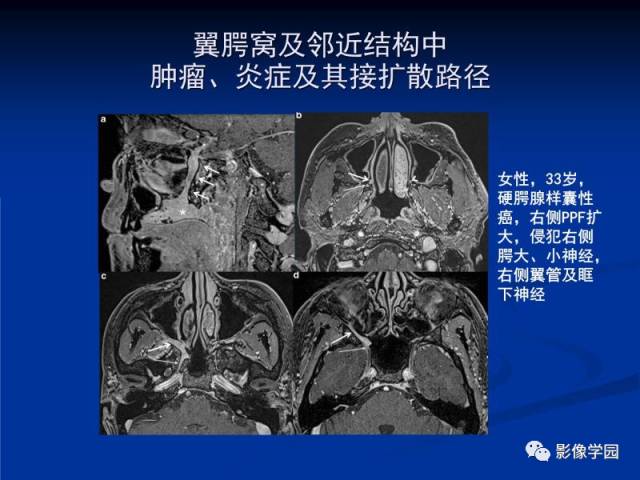 【PPT】翼腭窝PPF的解剖及影像学评价