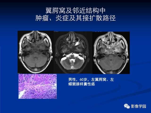 【PPT】翼腭窝PPF的解剖及影像学评价