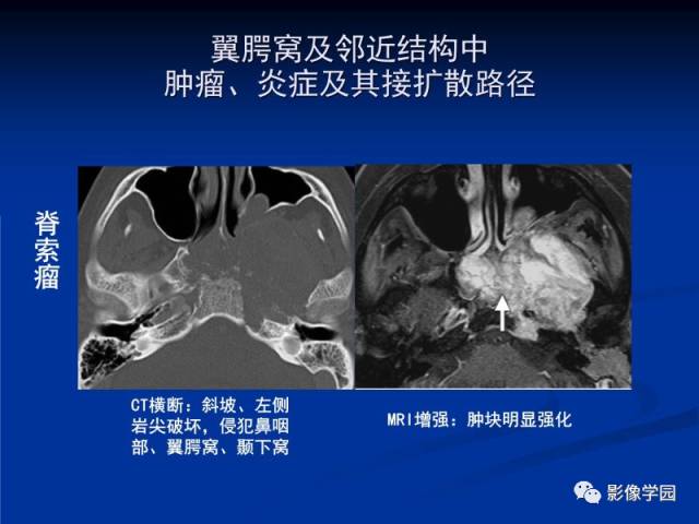 【PPT】翼腭窝PPF的解剖及影像学评价