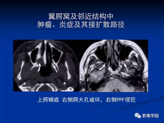 【PPT】翼腭窝PPF的解剖及影像学评价