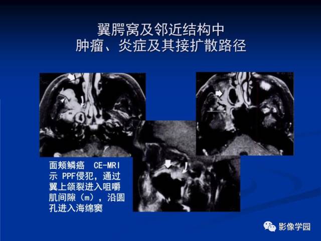 【PPT】翼腭窝PPF的解剖及影像学评价