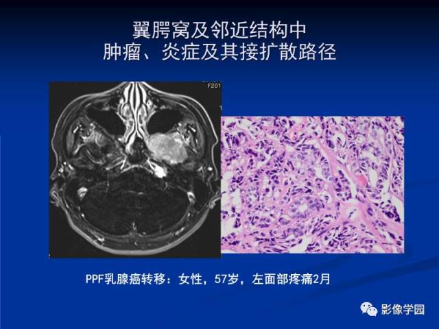 【PPT】翼腭窝PPF的解剖及影像学评价