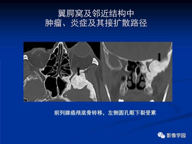 【PPT】翼腭窝PPF的解剖及影像学评价