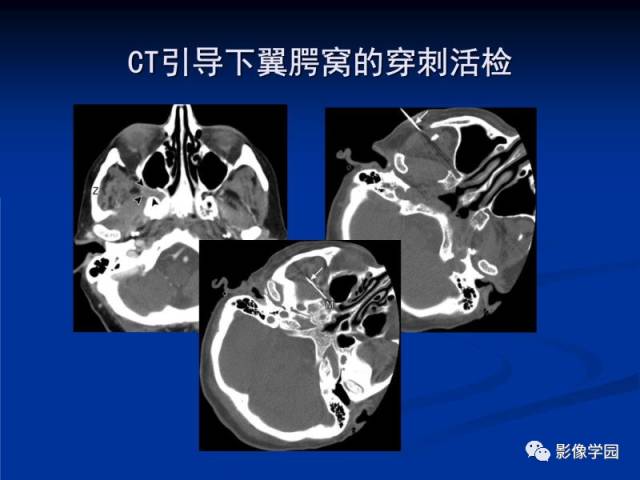 【PPT】翼腭窝PPF的解剖及影像学评价