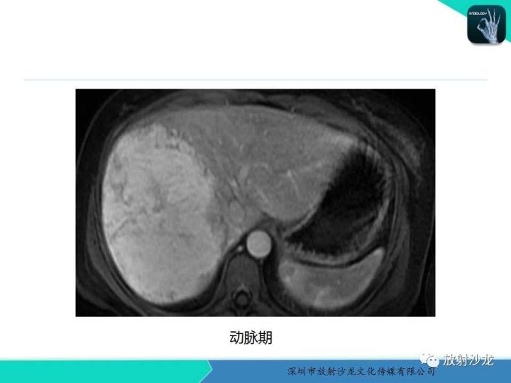 【病例】肝腺瘤1例MR