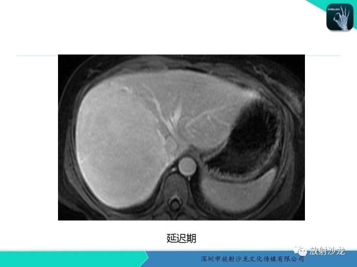 【病例】肝腺瘤1例MR