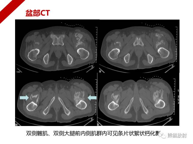 【病例】骨化性肌炎1例X线PET-CT及MR