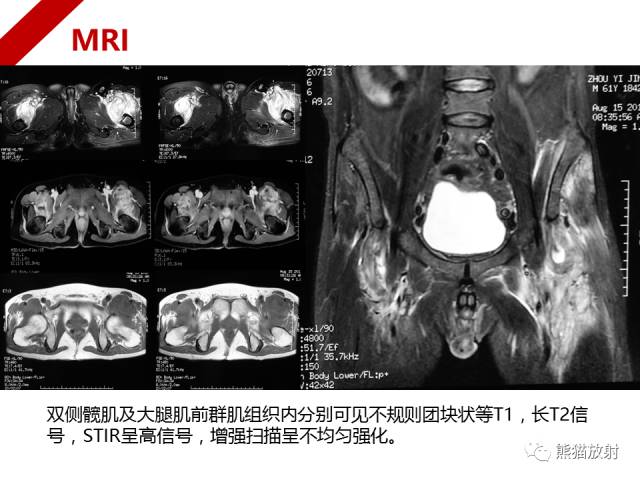 【病例】骨化性肌炎1例X线PET-CT及MR