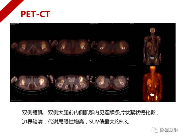 【病例】骨化性肌炎1例X线PET-CT及MR