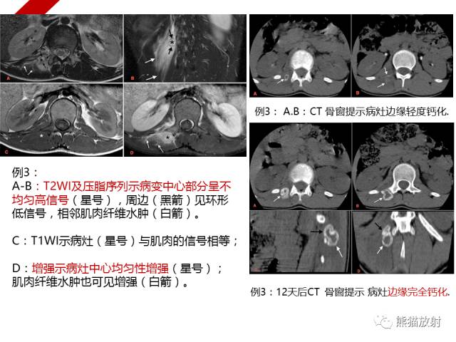 【病例】骨化性肌炎1例X线PET-CT及MR