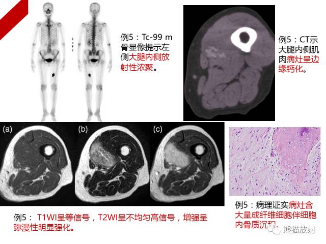 【病例】骨化性肌炎1例X线PET-CT及MR