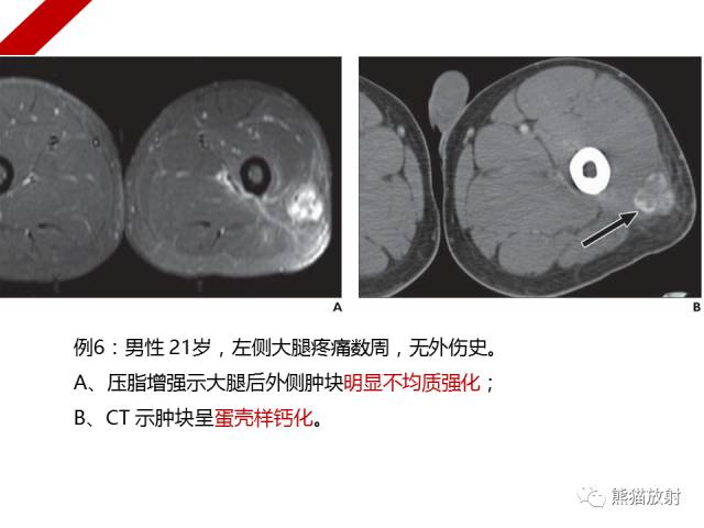 【病例】骨化性肌炎1例X线PET-CT及MR