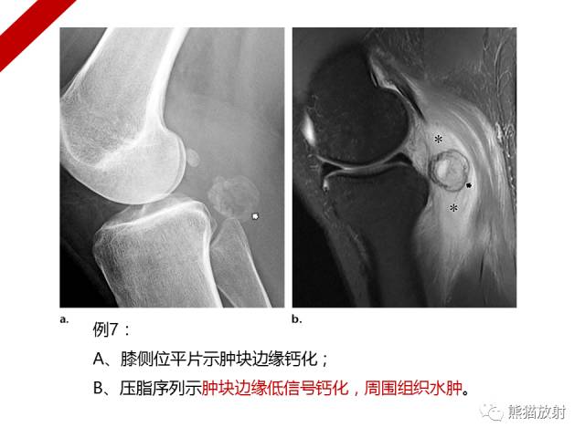 【病例】骨化性肌炎1例X线PET-CT及MR