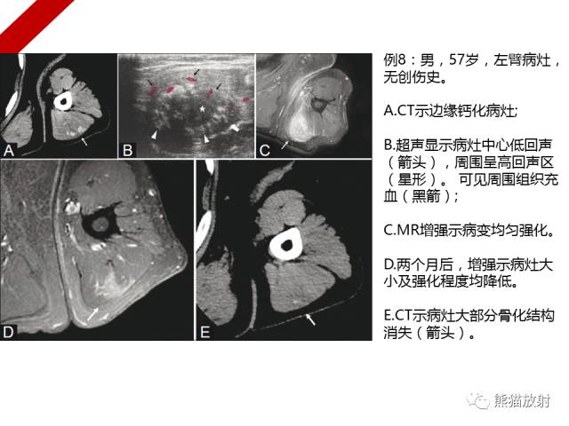 【病例】骨化性肌炎1例X线PET-CT及MR