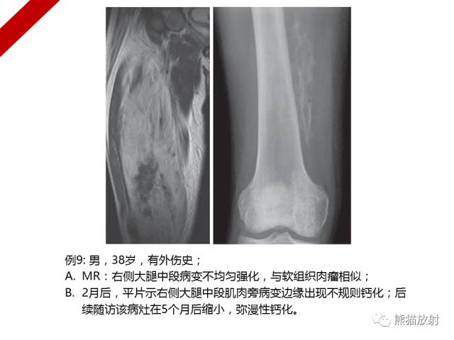 【病例】骨化性肌炎1例X线PET-CT及MR