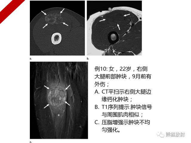 【病例】骨化性肌炎1例X线PET-CT及MR