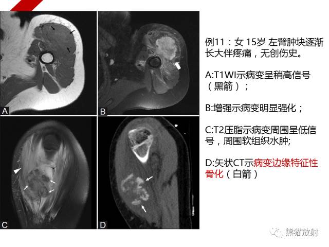 【病例】骨化性肌炎1例X线PET-CT及MR