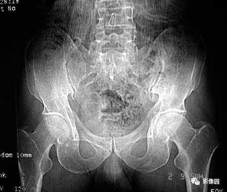 【病例】髂骨翼骨化性纤维瘤1例CT影像讨论 【病例】髂骨翼骨化性纤维瘤1例CT影像讨论