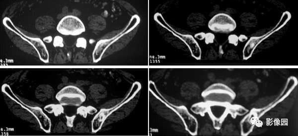 【病例】髂骨翼骨化性纤维瘤1例CT影像讨论 【病例】髂骨翼骨化性纤维瘤1例CT影像讨论