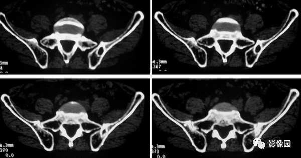 【病例】髂骨翼骨化性纤维瘤1例CT影像讨论 【病例】髂骨翼骨化性纤维瘤1例CT影像讨论