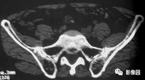 【病例】髂骨翼骨化性纤维瘤1例CT影像讨论 【病例】髂骨翼骨化性纤维瘤1例CT影像讨论