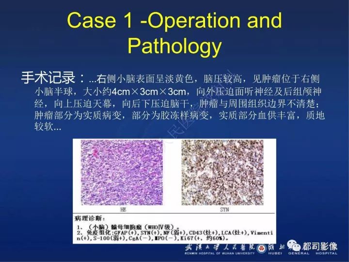 【PPT】后颅窝肿瘤性病变影像诊断