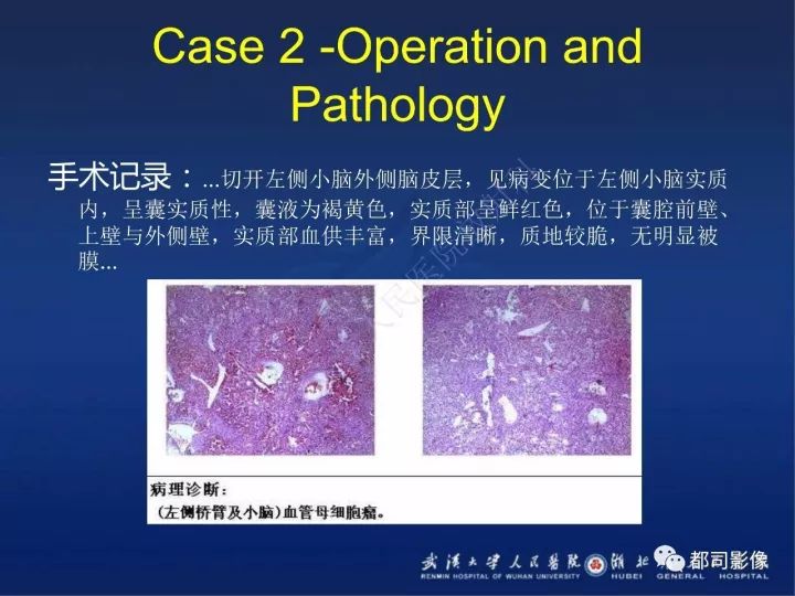 【PPT】后颅窝肿瘤性病变影像诊断