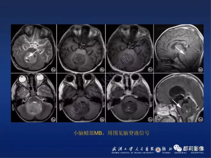 【PPT】后颅窝肿瘤性病变影像诊断