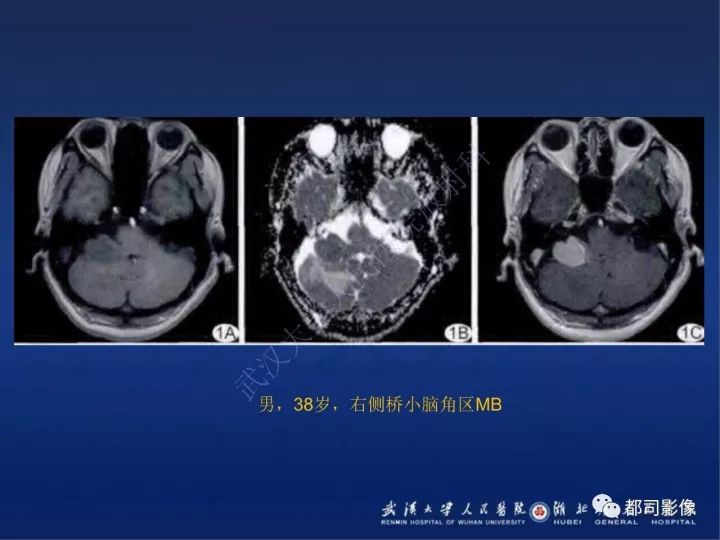 【PPT】后颅窝肿瘤性病变影像诊断
