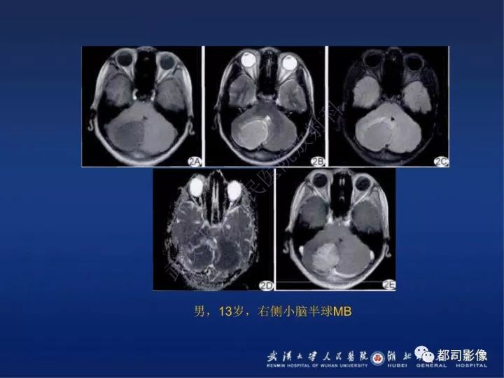 【PPT】后颅窝肿瘤性病变影像诊断