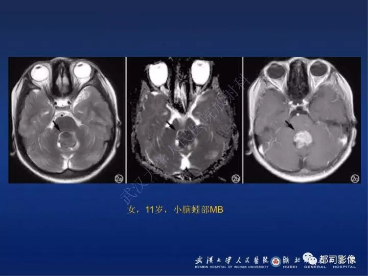 【PPT】后颅窝肿瘤性病变影像诊断