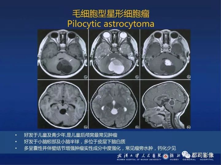 【PPT】后颅窝肿瘤性病变影像诊断