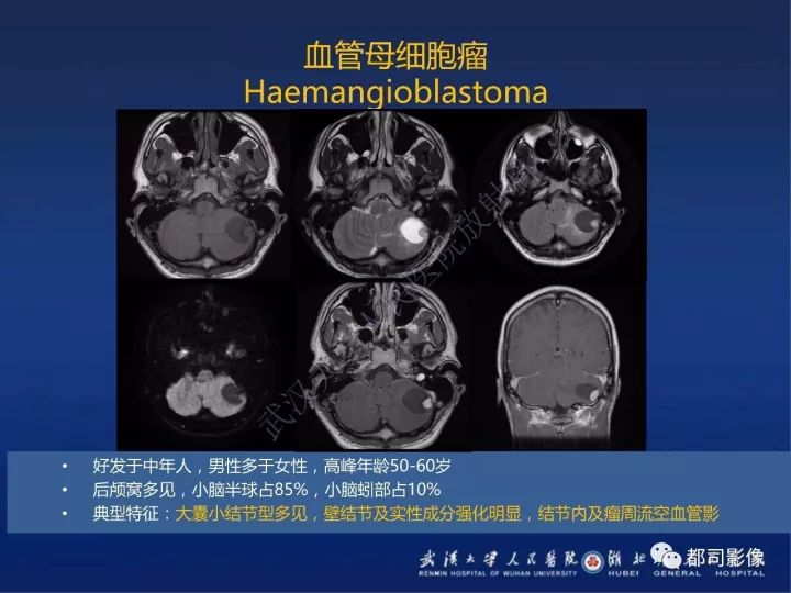 【PPT】后颅窝肿瘤性病变影像诊断