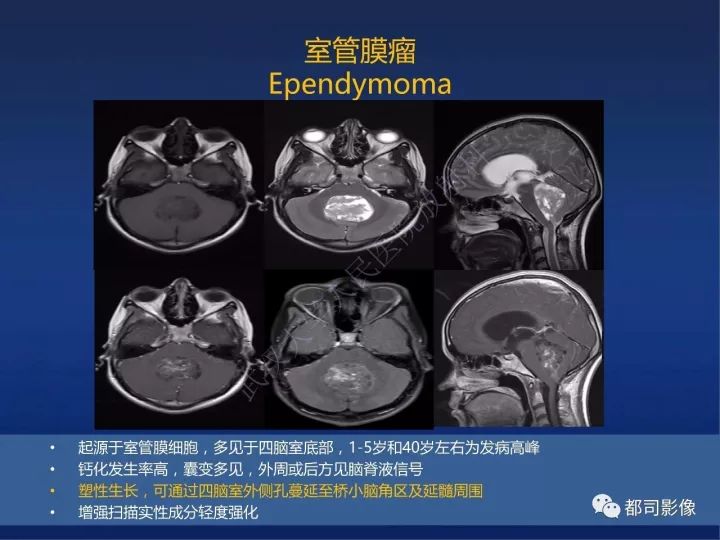 【PPT】后颅窝肿瘤性病变影像诊断