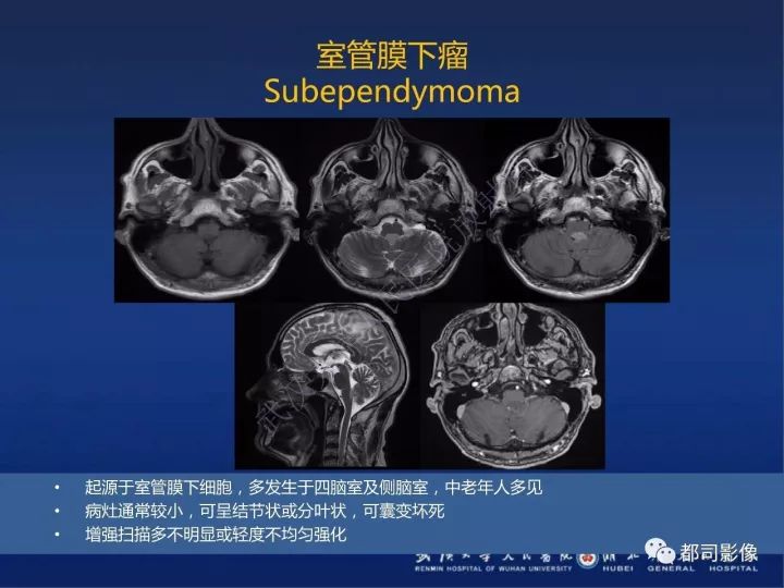 【PPT】后颅窝肿瘤性病变影像诊断