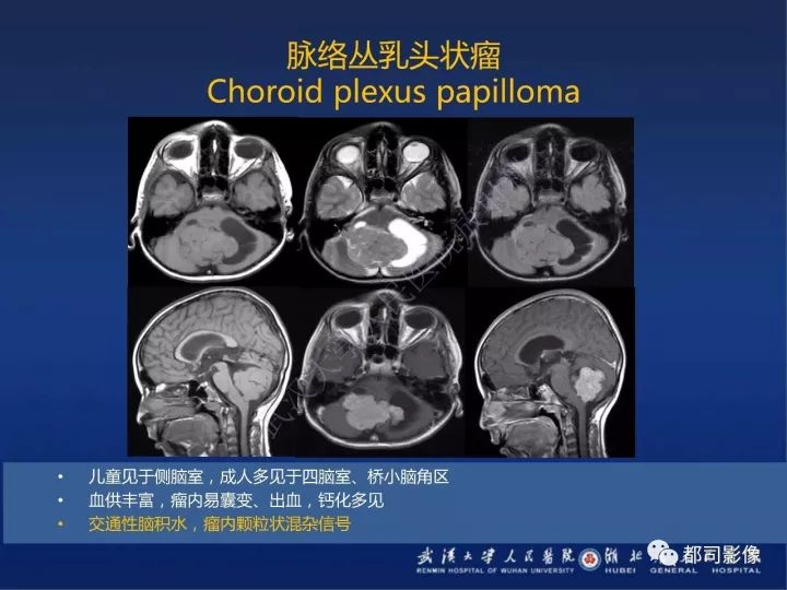 【PPT】后颅窝肿瘤性病变影像诊断
