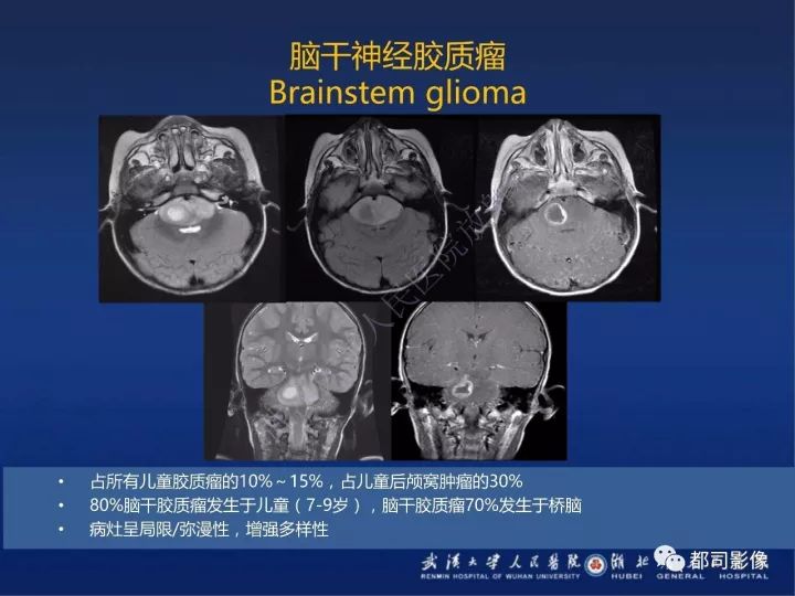 【PPT】后颅窝肿瘤性病变影像诊断