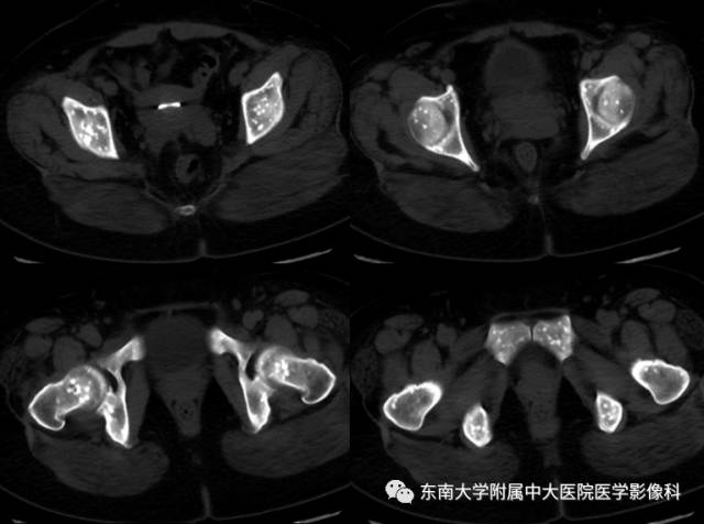 【病例】骨斑点症1例CT