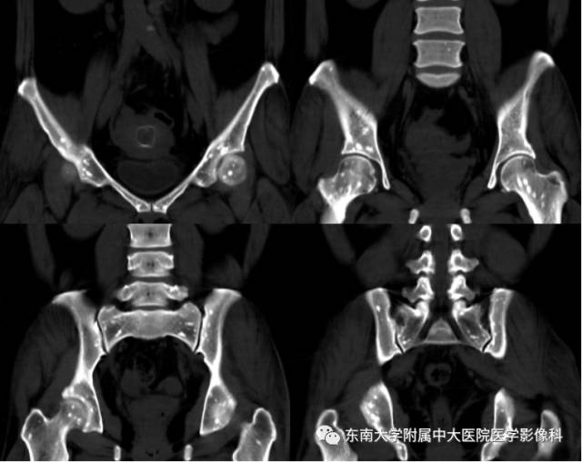 【病例】骨斑点症1例CT
