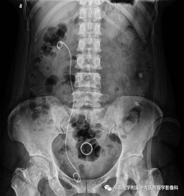 【病例】骨斑点症1例CT