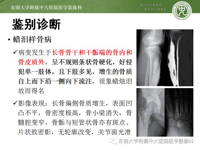 【病例】骨斑点症1例CT