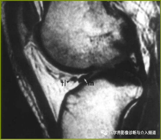 容易误诊为半月板损伤的11种结构 容易误诊为半月板损伤的11种结构