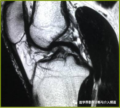 容易误诊为半月板损伤的11种结构 容易误诊为半月板损伤的11种结构