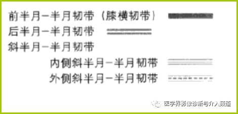 容易误诊为半月板损伤的11种结构 容易误诊为半月板损伤的11种结构