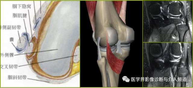 容易误诊为半月板损伤的11种结构 容易误诊为半月板损伤的11种结构