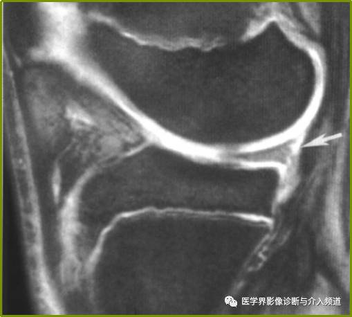 容易误诊为半月板损伤的11种结构 容易误诊为半月板损伤的11种结构