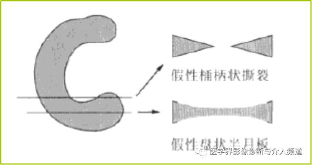 容易误诊为半月板损伤的11种结构 容易误诊为半月板损伤的11种结构